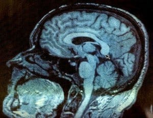Traumatic Brain Injury Increasingly Common as Public Becomes Increasingly Aware